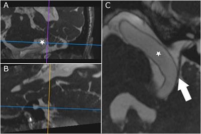 Case report: Bitter vertigo